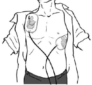 電極パッドを傷病者の胸に貼るの画像
